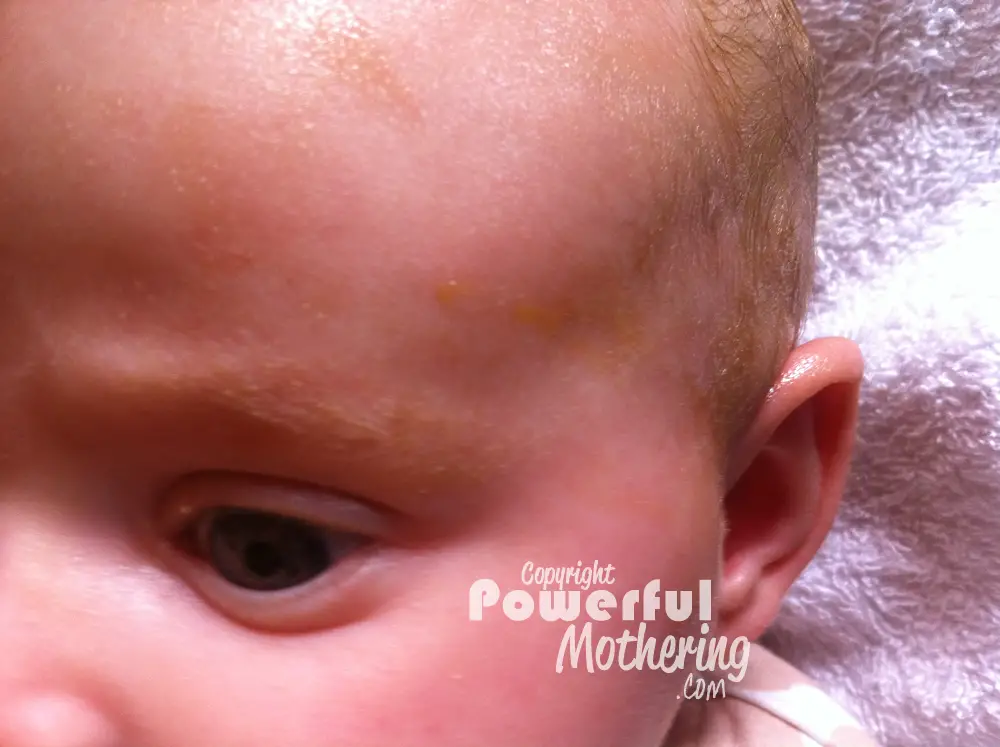 What is the scientific name for cradle cap?